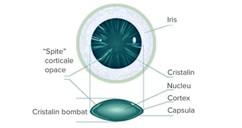 Cataracta corticala