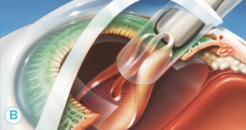 Ce presupune operatia de cataracta?