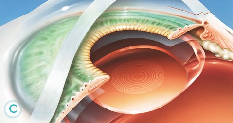 Ce presupune operatia de cataracta?