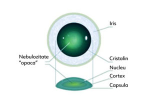 1 Cataracta nucleara scaled
