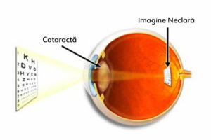1 De ce apare cataracta