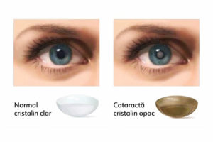 2 Ce este cataracta