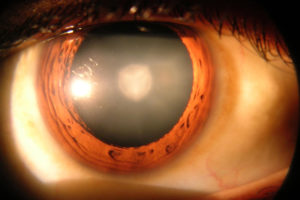 3 Cauze secundare cataracta cum arata cataracta