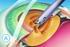 5 ce presupune operatia de cataracta 1