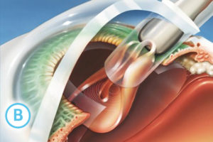 6 ce presupune operatia de cataracta 2