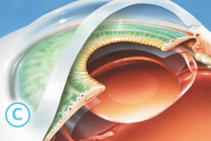 7 ce presupune operatia de cataracta 3